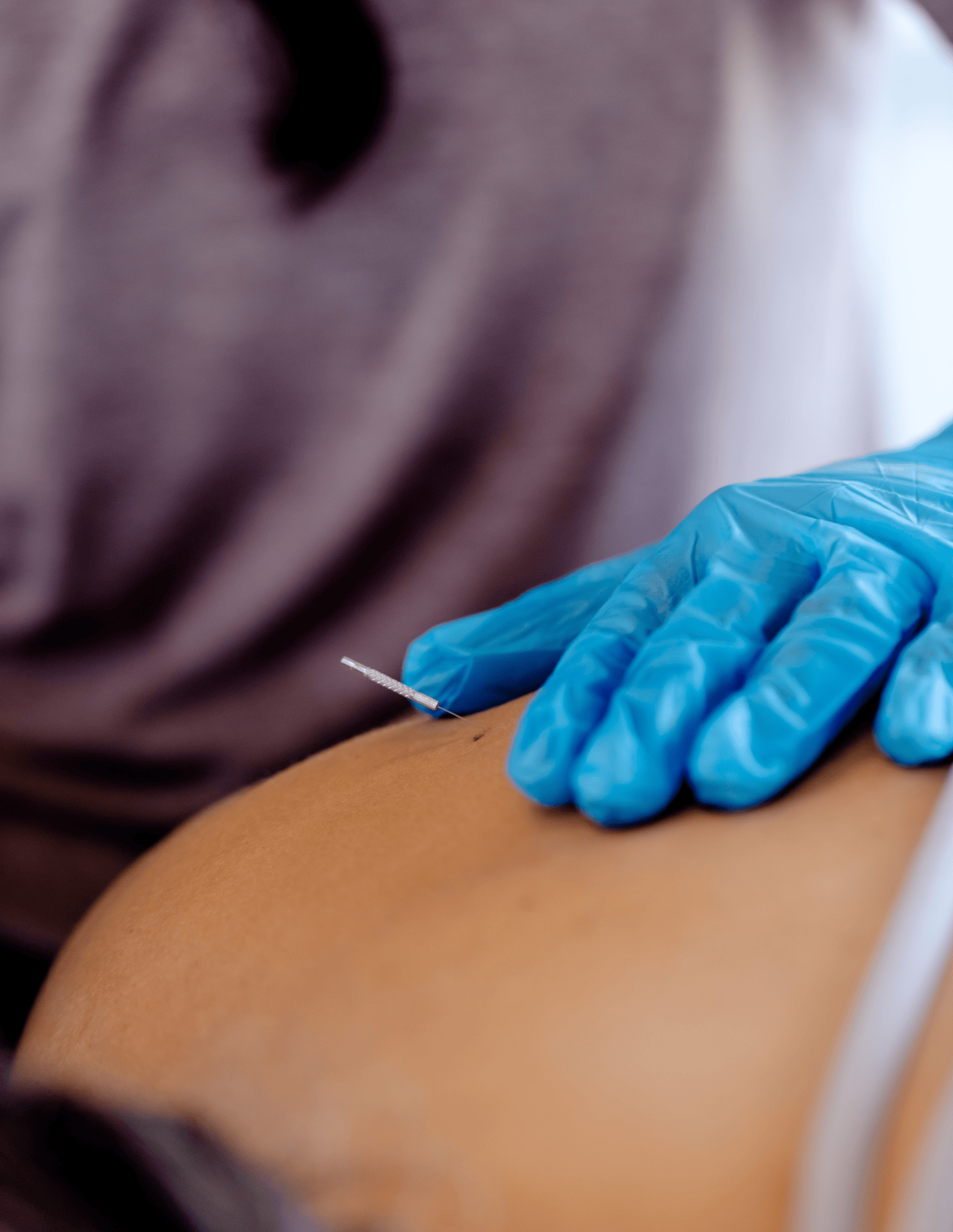 What Are The 21 Physical Therapy Dry Needling Benefits?