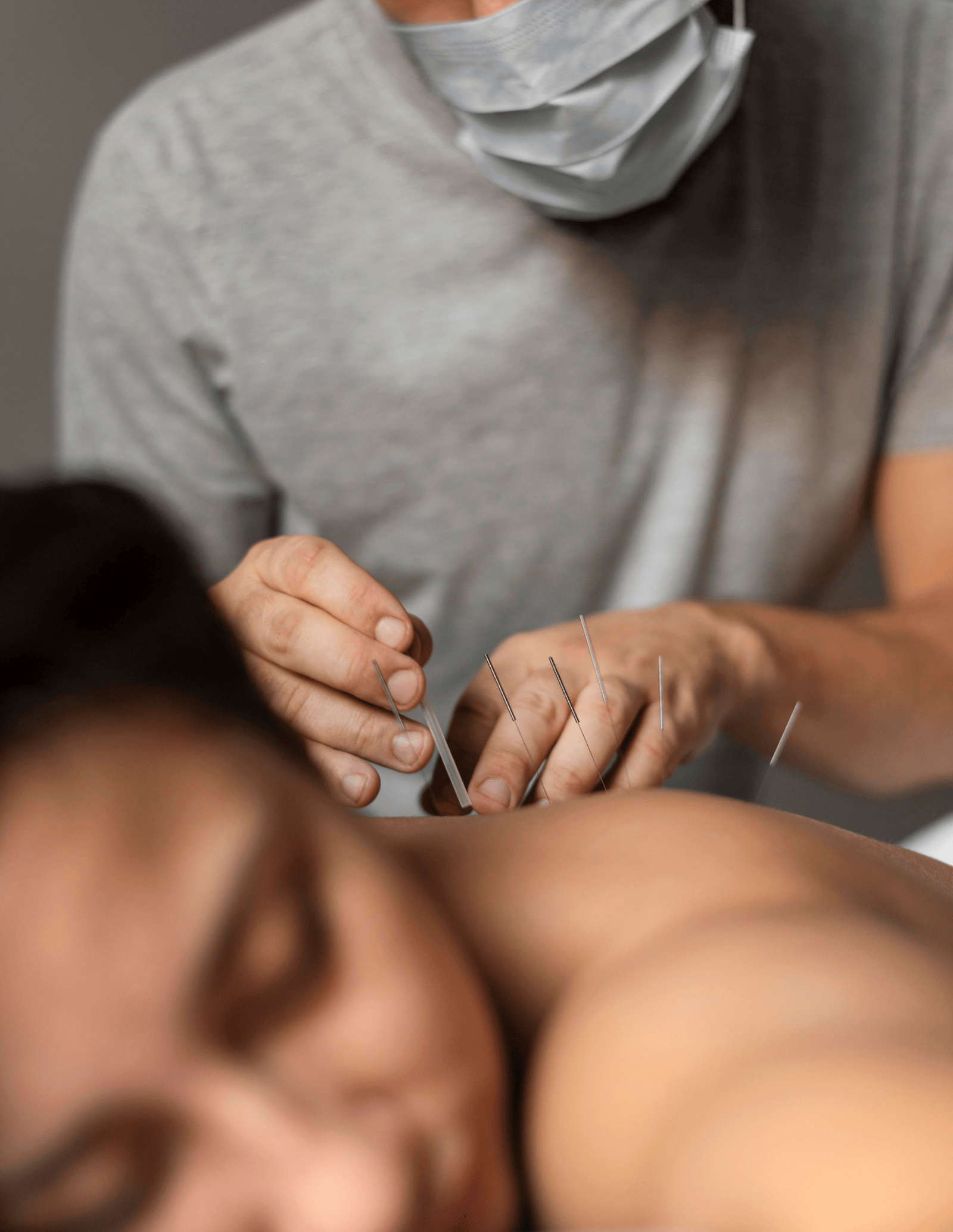 What Does Dry Needling Do & How Does it Work in Physical Therapy